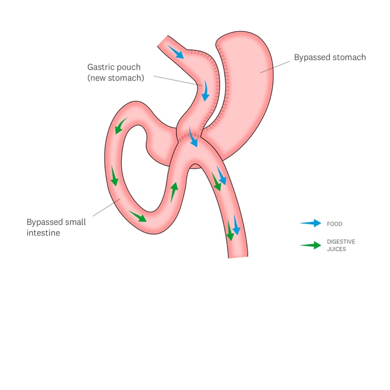 Diagram of a mini gastric bypass, showing the gastric pouch and bypassed small intestine, with food and digestive-juice pathways marked.