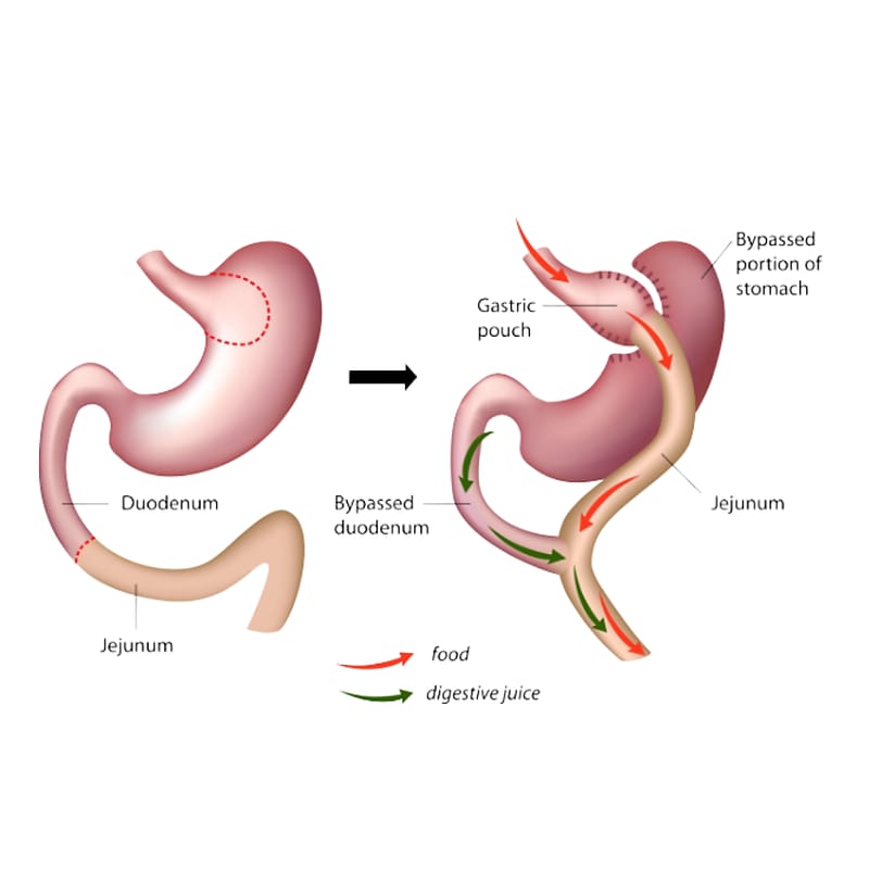 Diagram of a Roux-en-Y gastric bypass, showing the gastric pouch, bypassed stomach and rerouted jejunum.