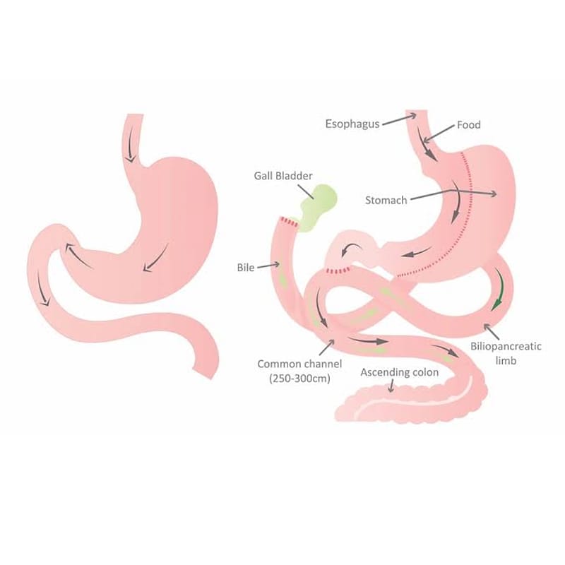 Diagram of a SADI / duodenal switch-type procedure, showing the stomach, common channel, biliopancreatic limb and ascending colon.